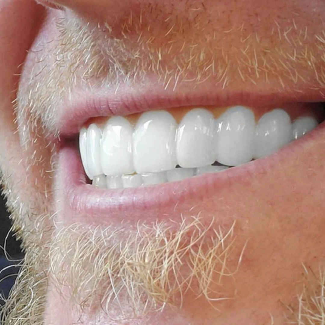 EasySmile | Facetas dentárias de cerâmica adaptáveis